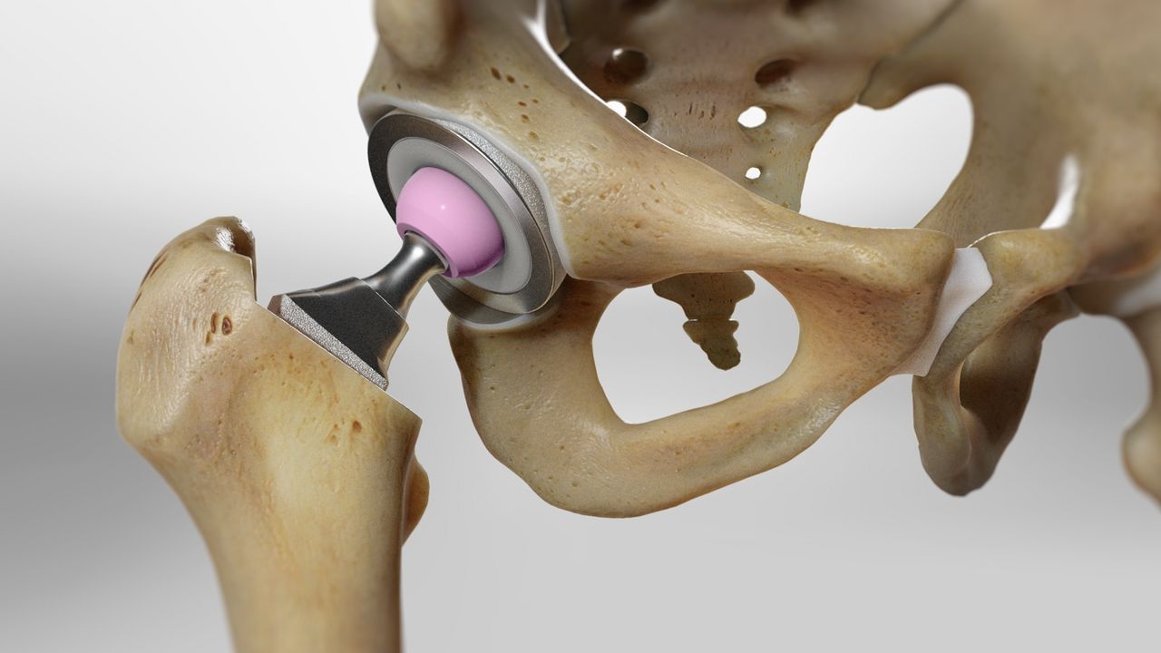 Hip Replacement Surgery Jaipur